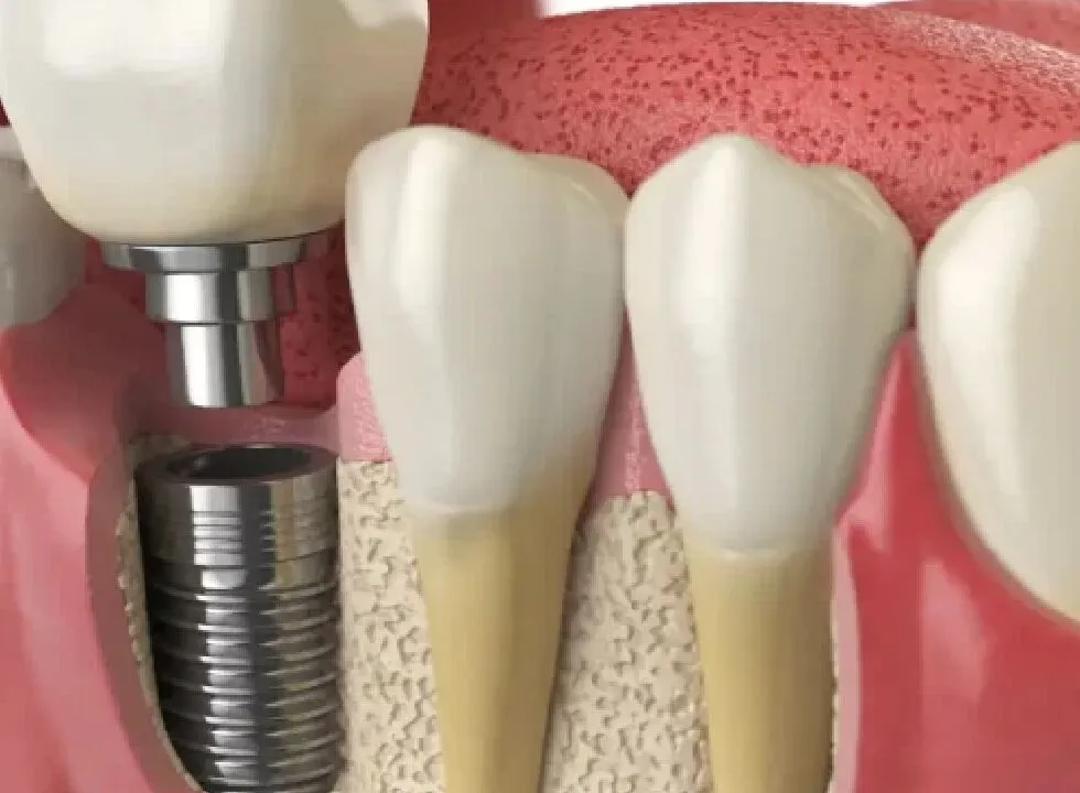 The Role of 3D Technology in Modern Dental Implants Surgery
